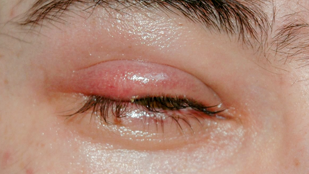 How To Get Rid Of A Stye In Your Eye?